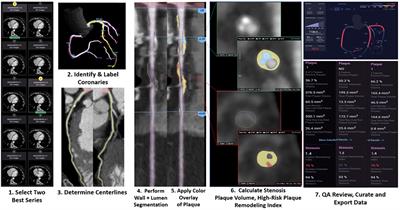 Artificial Intelligence Advancements in the Cardiovascular Imaging of Coronary Atherosclerosis